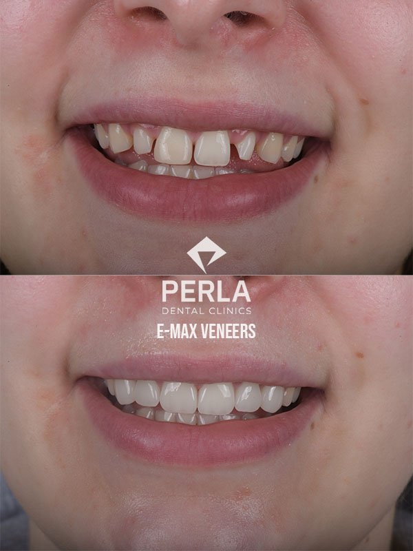 Veneers at Perla Dental Before After