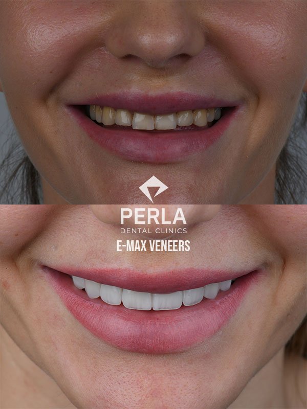 Veneers at Perla Dental Before and After