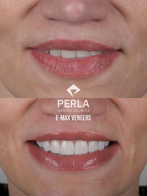 Veneers at Perla Dental Clinics Before After