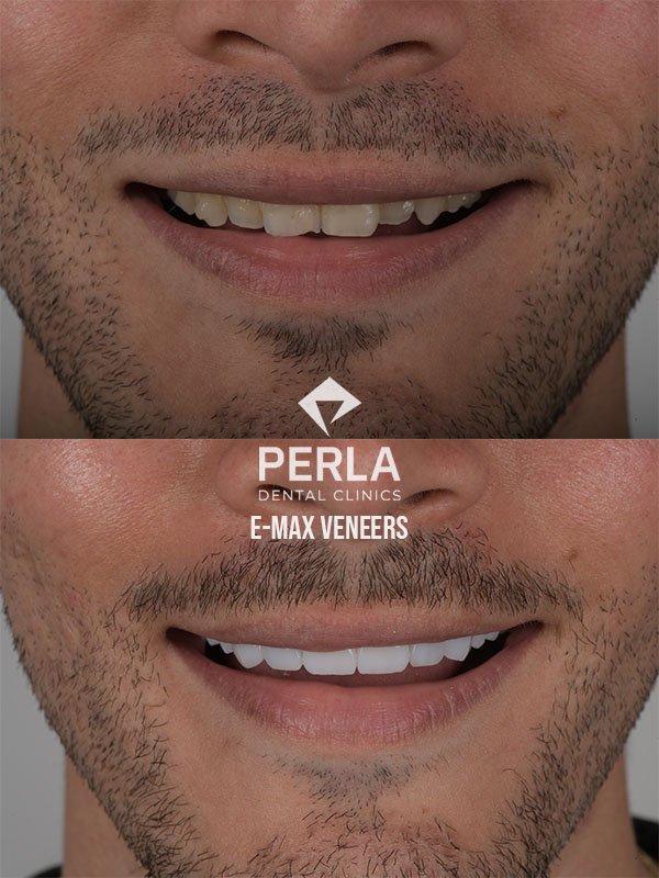 Veneers at Perla Dental Clinics Before and After