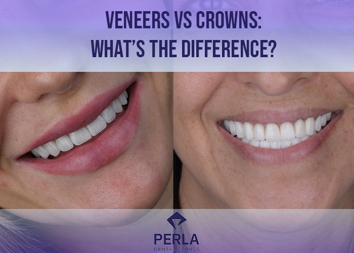 Veneers vs Crowns What’s the Difference