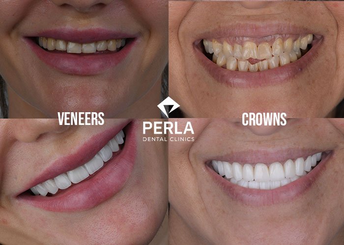 Veneers vs Crowns