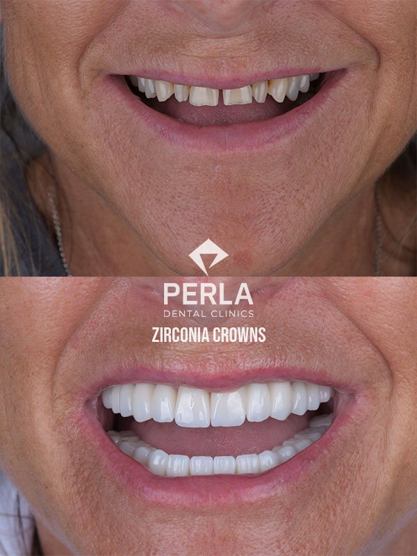 Zirconia Crowns at Perla Dental Before After