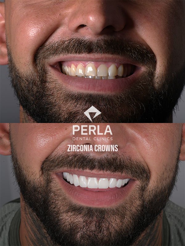 Zirconia Crowns at Perla Dental Before and After