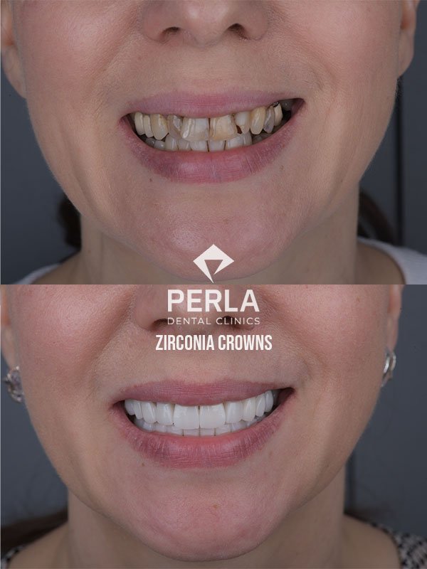 Zirconia Crowns at Perla Dental Clinics Before After