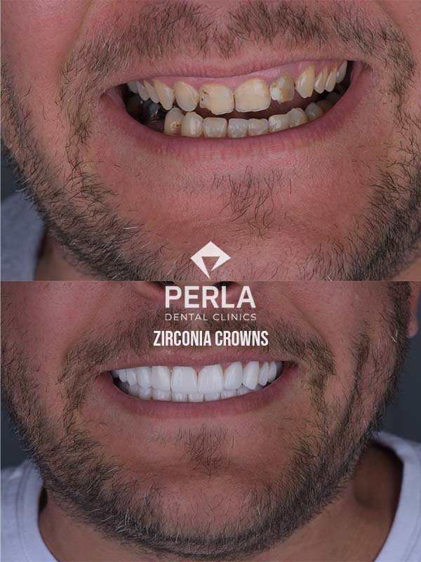 Zirconia Crowns at Perla Dental Clinics Before and After