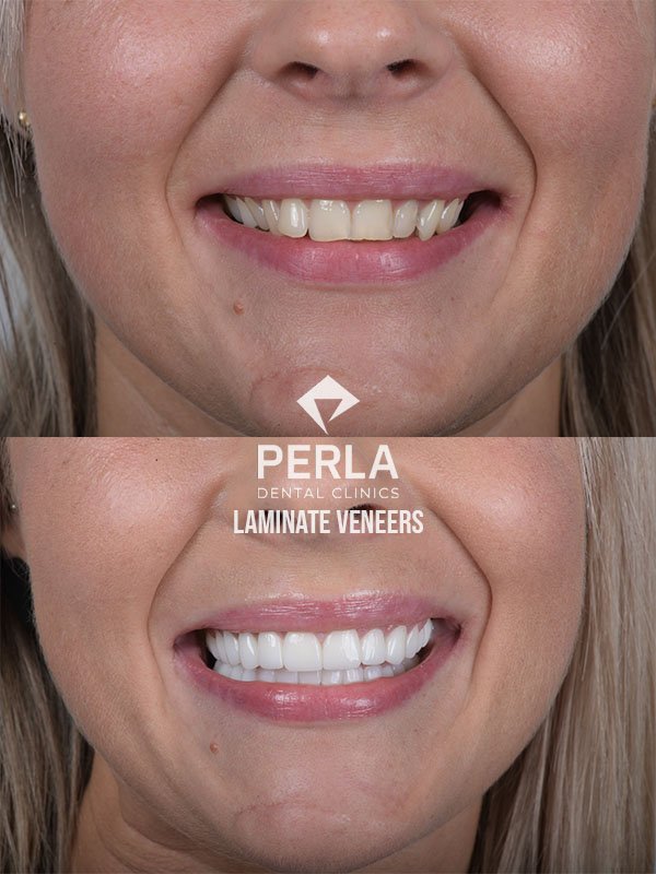 laminate veneers at Perla dental clinics Antalya