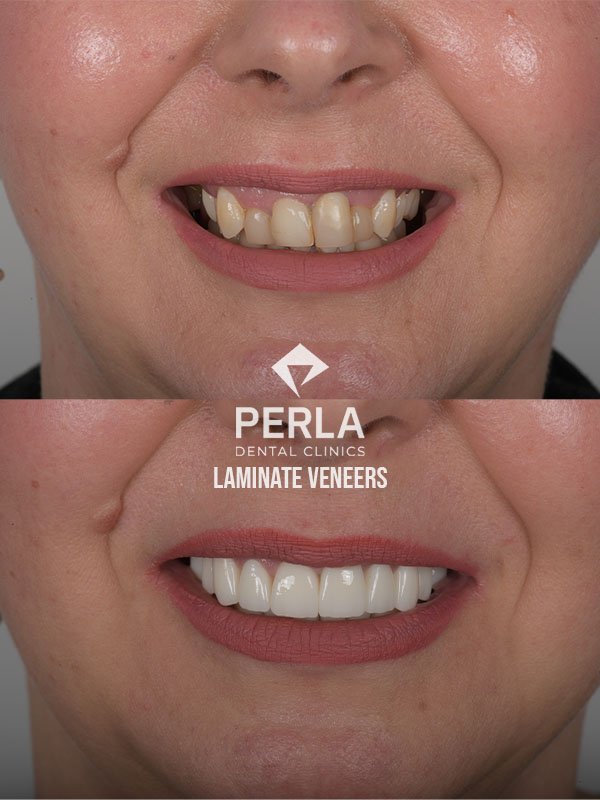 laminate veneers before after at Perla dental clinics Antalya
