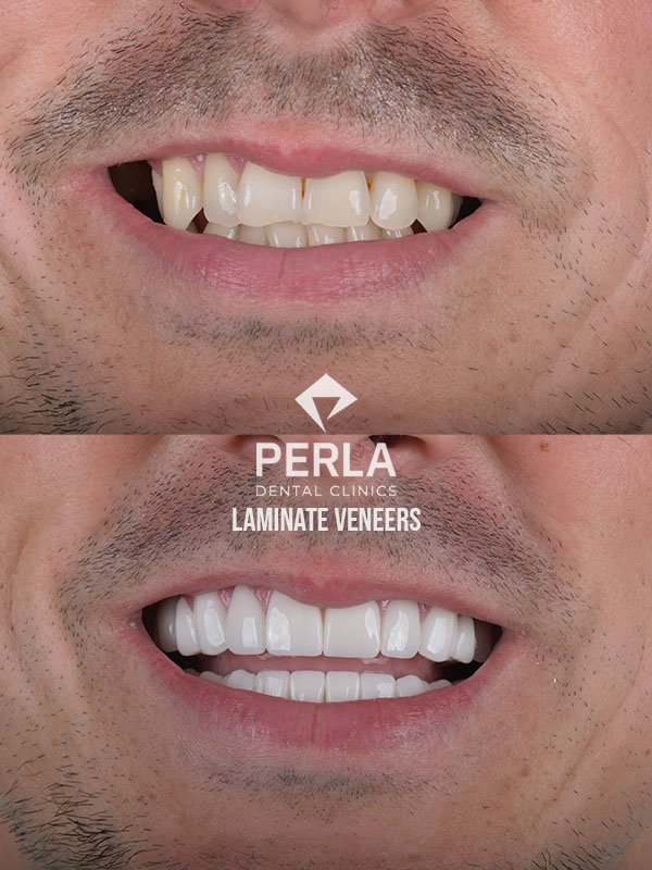 laminate veneers before after at Perla dental clinics Turkey
