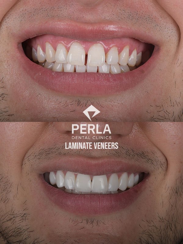 laminate veneers before after at Perla dental clinics in Antalya