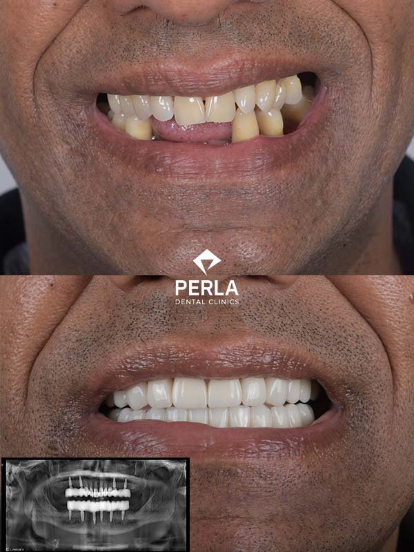 All on 6 Implants in Turkey Before After Results​ Perla Dental Antalya