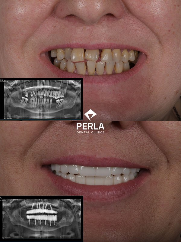 All on 6 Implants in Turkey Before After Results​ Perla Dental Clinics Antalya
