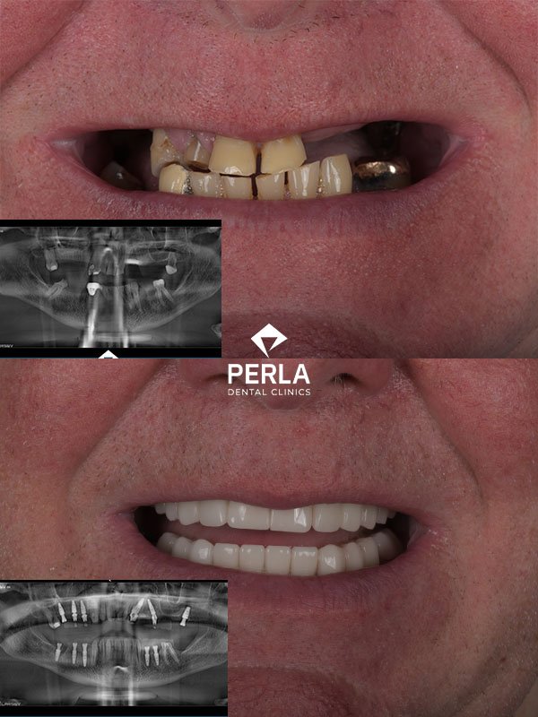 All on 6 Implants in Turkey Before After Results​ Perla Dental
