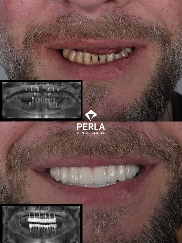 All on 6 Implants in Turkey Before After Results​