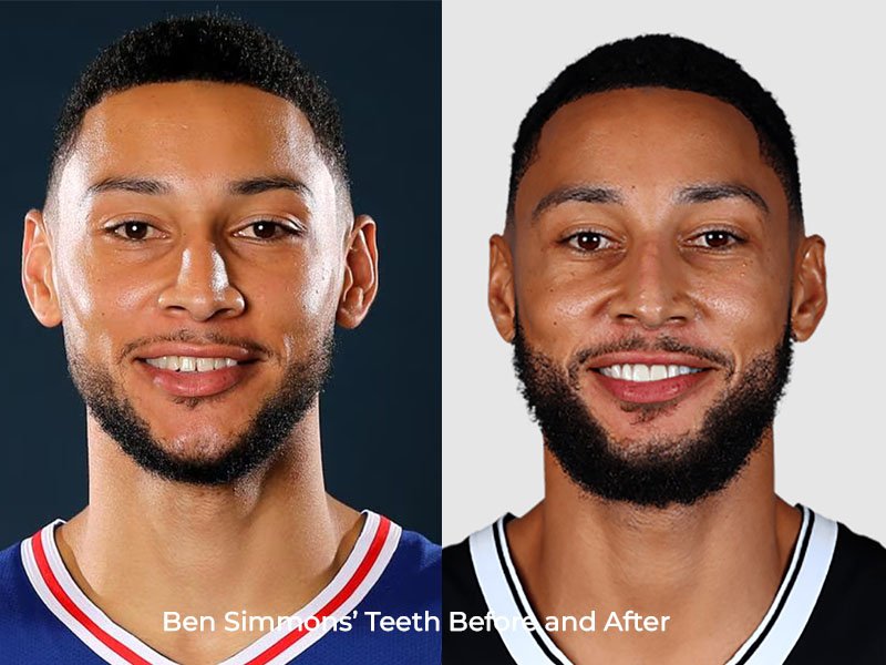 Ben Simmons Teeth Before and After