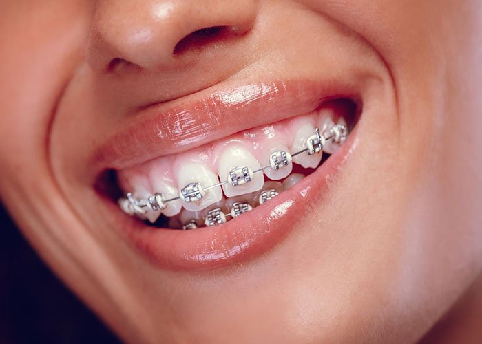 Composite Bonding vs Braces