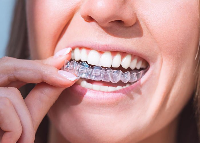 Composite Bonding vs Clear Aligners