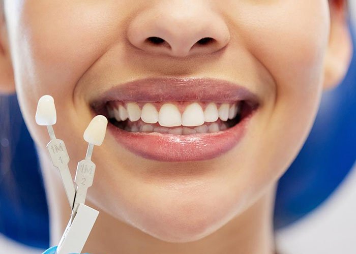 Composite Bonding vs Veneers