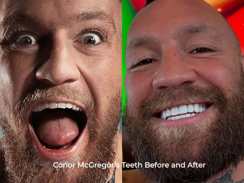 Conor McGregor Teeth Before and After