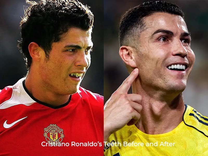 Cristiano Ronaldo Teeth Before and After