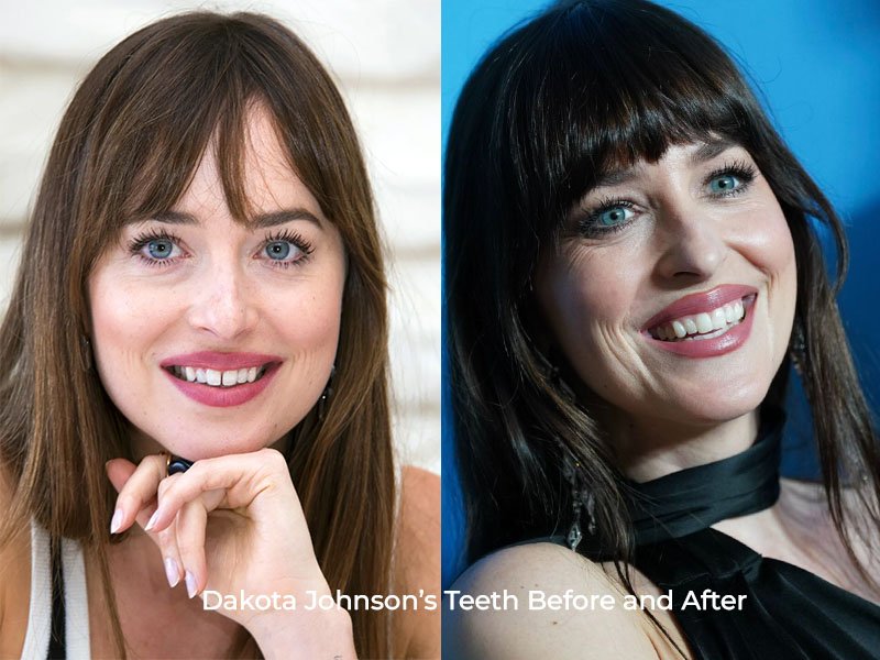 Dakota Johnson Teeth Before and After