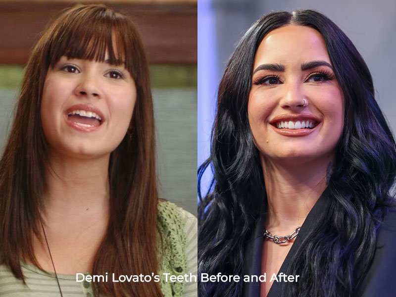 Demi Lovato Teeth Before and After