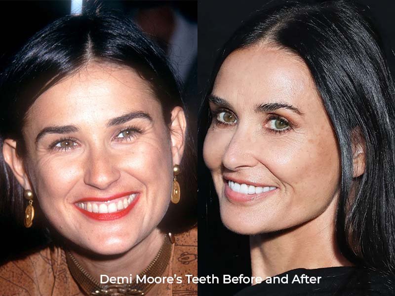 Demi Moore Teeth Before and After