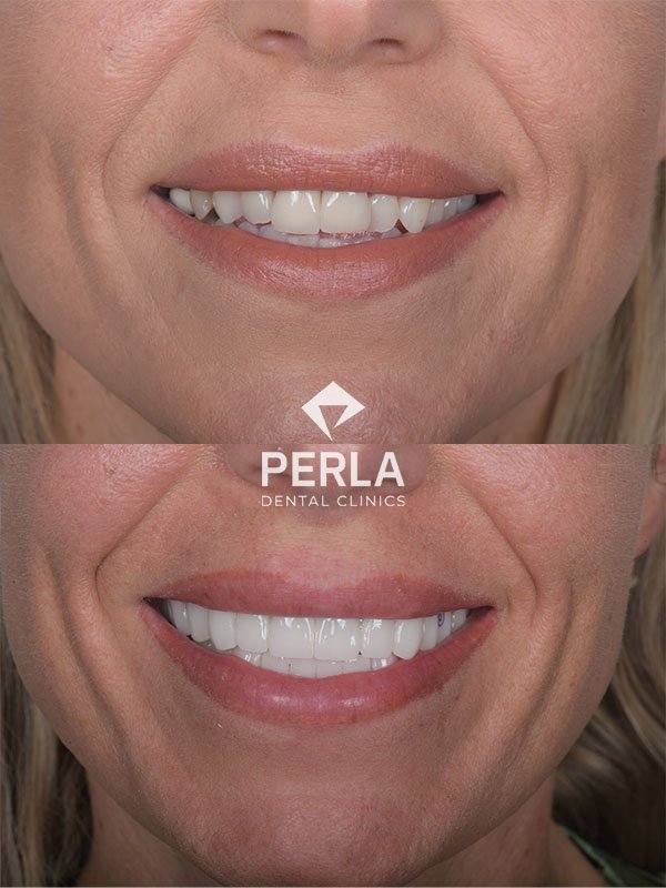 Dental Implants in Turkey Antalya before after Perla Dental