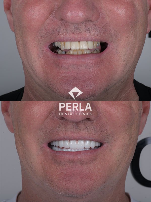 Dental Implants in Turkey Antalya before after at Perla Dental