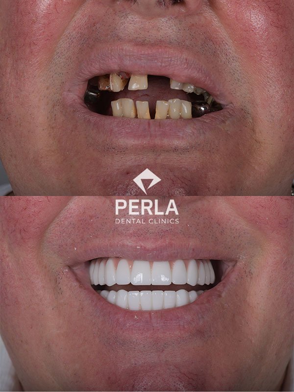 Dental Implants in Turkey Antalya before after