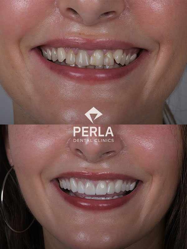 Dental Implants in Turkey Antalya before and after at Perla Dental