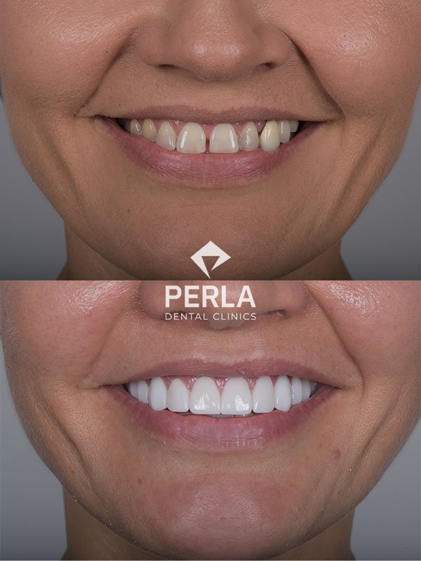 Dental Implants in Turkey before after Perla dental clinics
