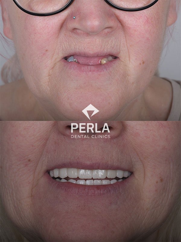 Dental Implants in Turkey before after