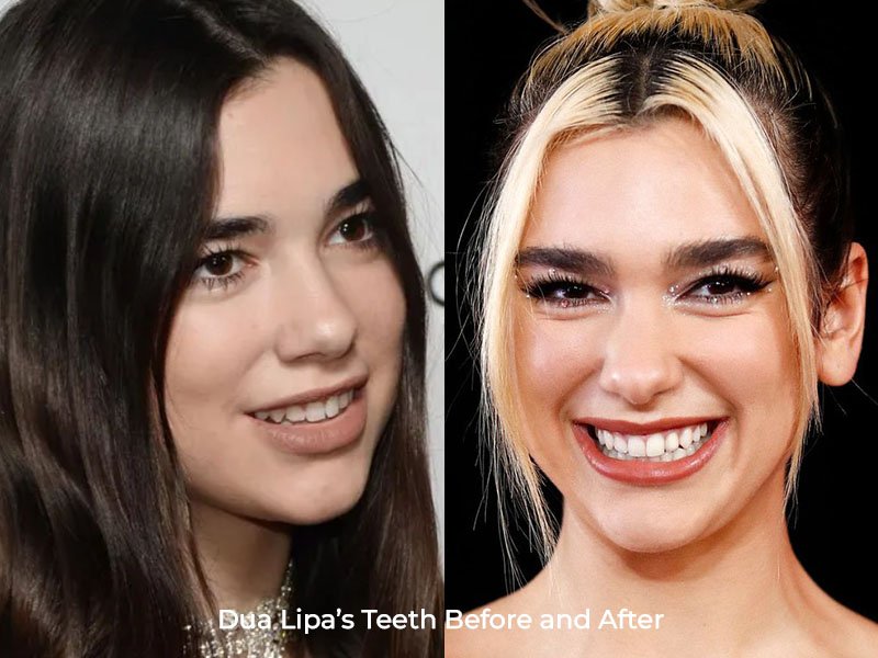 Dua Lipa Teeth Before and After