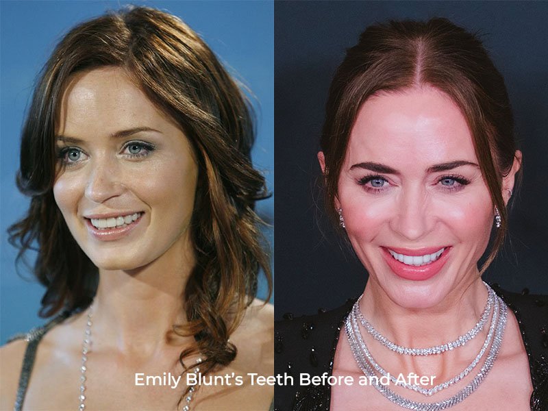 Emily Blunt Teeth Before and After