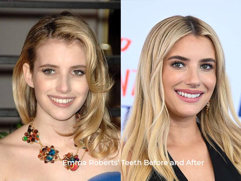 Emma Roberts Teeth Before and After