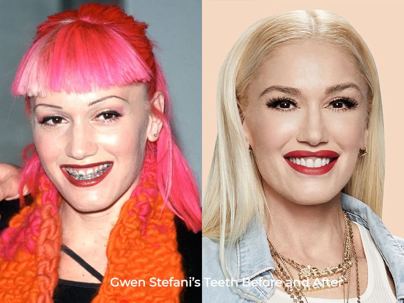 Gwen Stefani Teeth Before and After