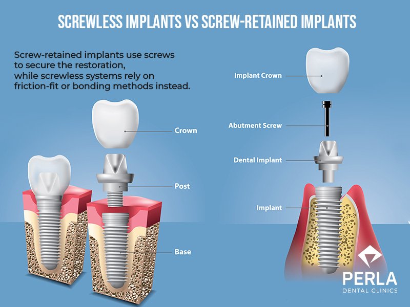 Screwless Dental Implants: Benefits, Risks and How They Work How Screwless Implants Differ from Traditional Implants