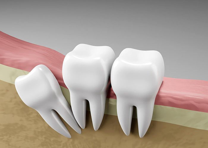 Impacted wisdom teeth