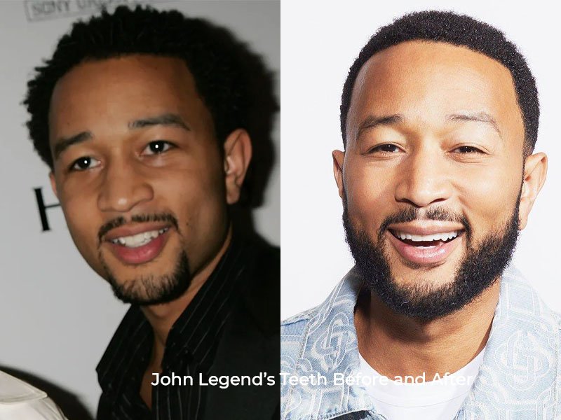 John Legend Teeth Before and After