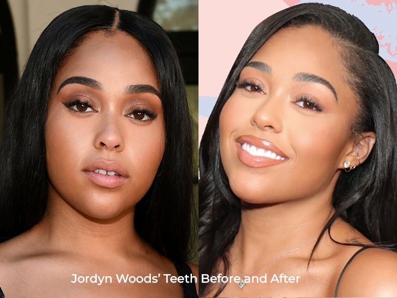 Jordyn Woods Teeth Before and After