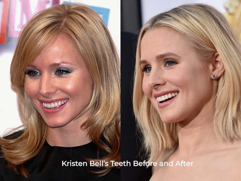 Kristen Bell Teeth Before and After