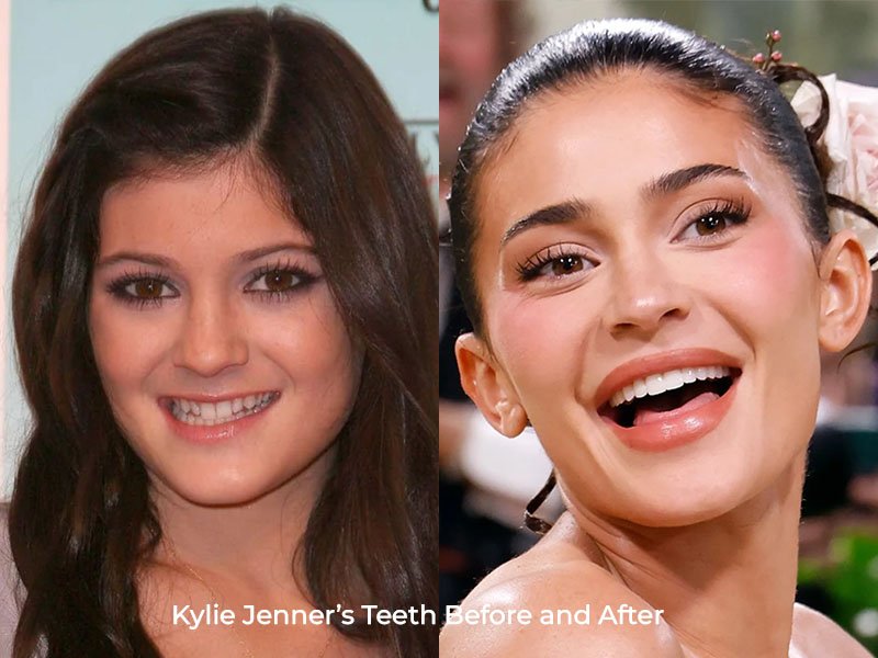 Kylie Jenner Teeth Before and After
