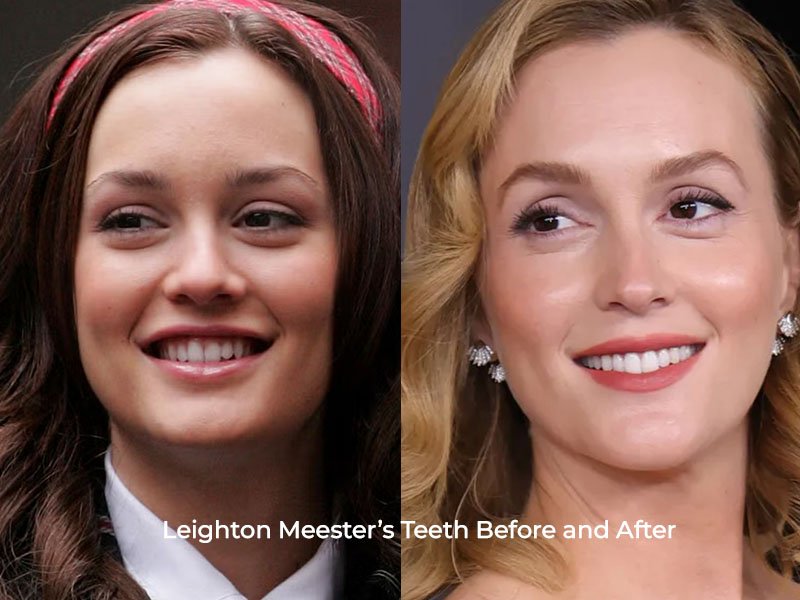 Leighton Meester Teeth Before and After