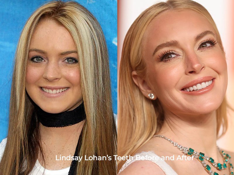 Lindsay Lohan Teeth Before and After
