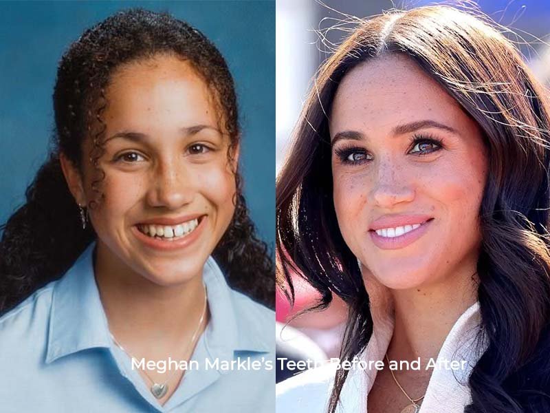Meghan Markle Teeth Before and After