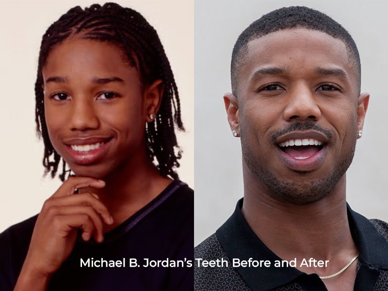 Michael B. Jordan Teeth Before and After
