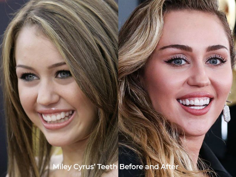 Miley Cyrus Teeth Before and After