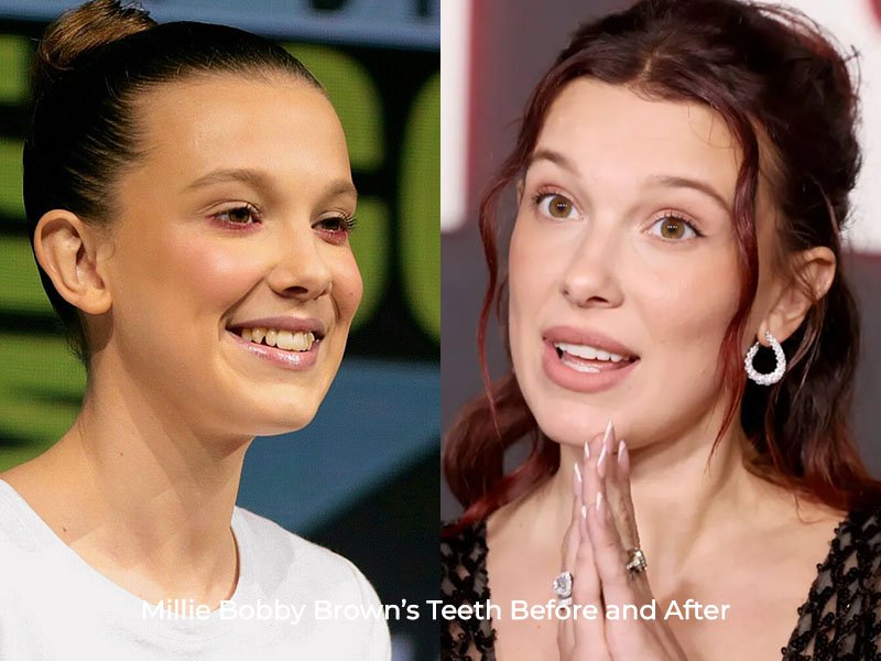 Millie Bobby Brown Teeth Before and After