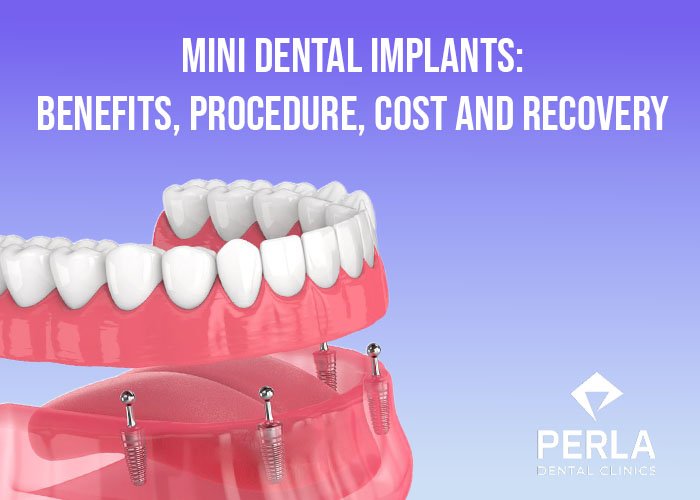 Mini Dental Implants Benefits Procedure Cost Recovery